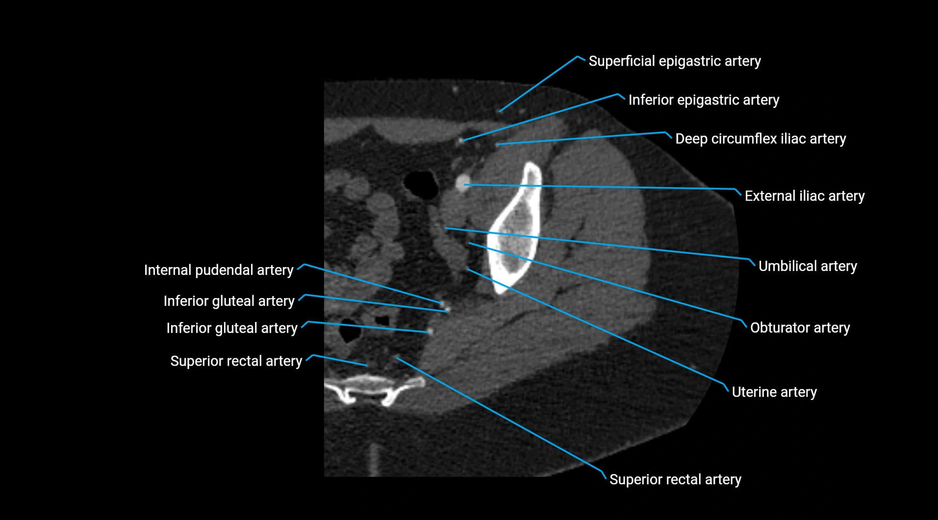 CTA lower limb cross sectional anatomy labelled image _42.webp